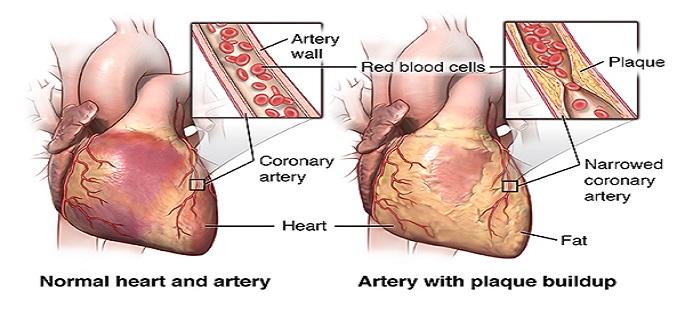 Coronary Artery Bypass Grafting Discharge Instructions Part2